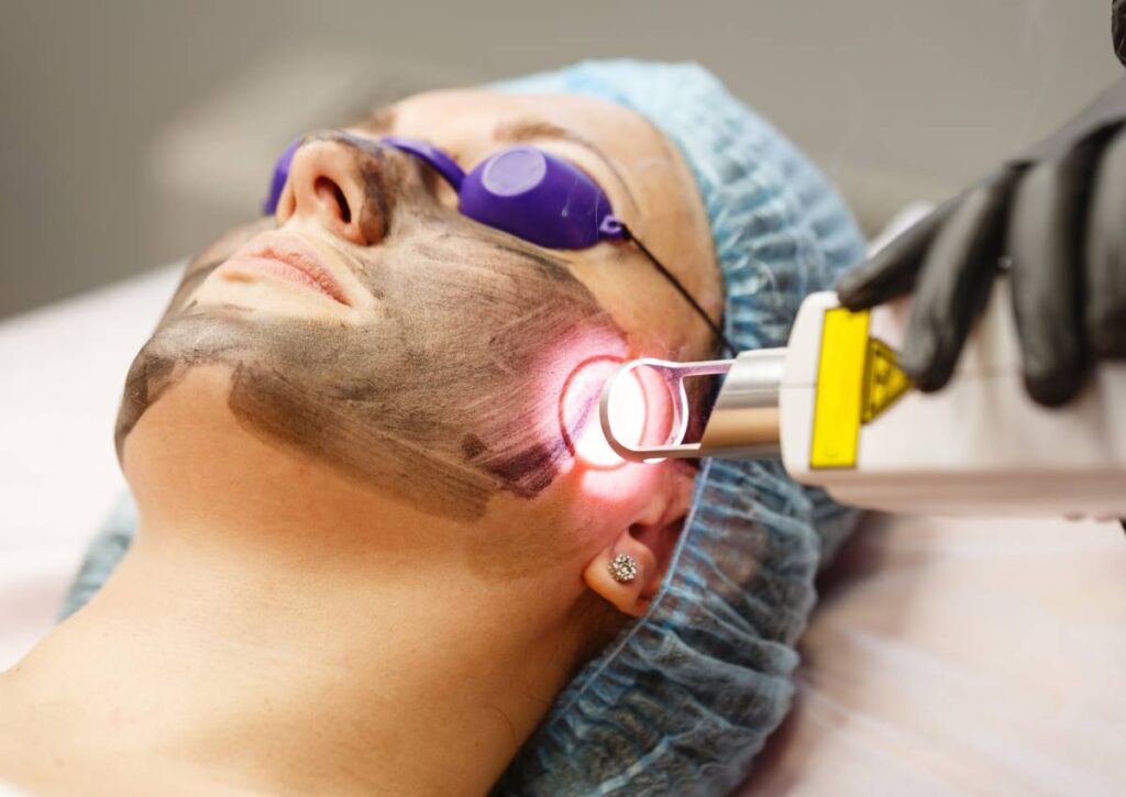 Best Carbon Laser Peel Treatment In Janakpuri