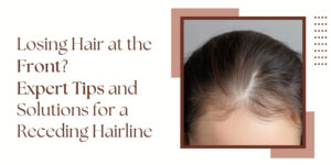hair loss treatment in Delhi