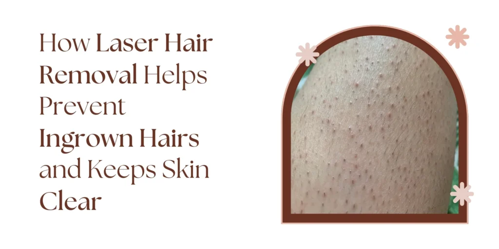 Laser Hair Removal in Delhi