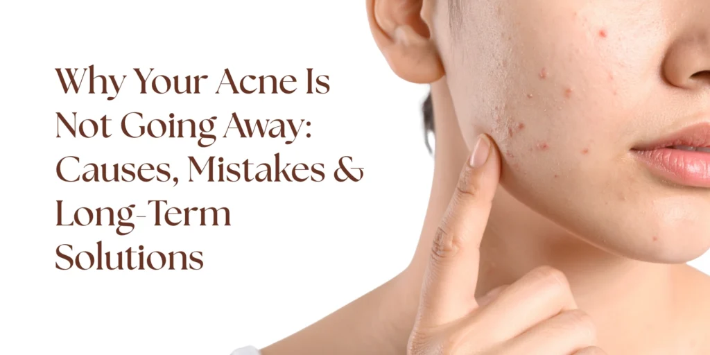 Acne not going away reasons