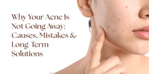 Acne not going away reasons