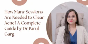 Acne treatment session results