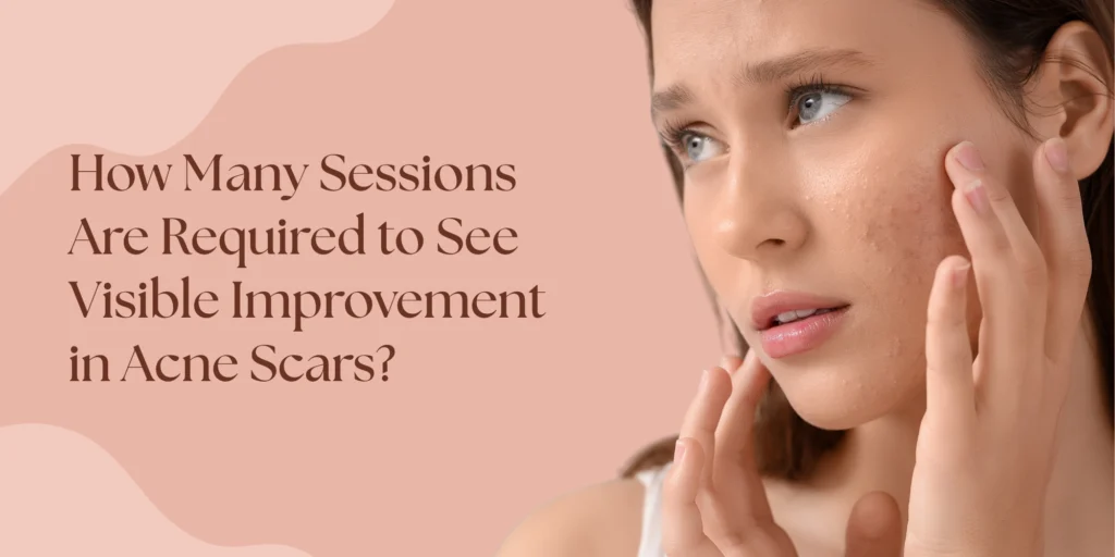 acne scar treatment sessions visible improvement West Delhi