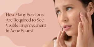 acne scar treatment sessions visible improvement West Delhi