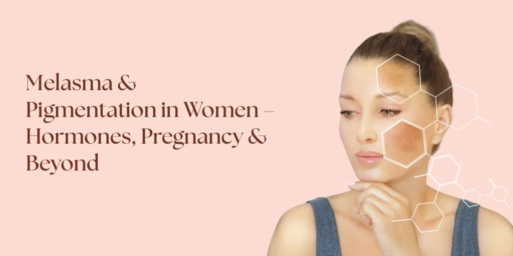melasma treatment West Delhi